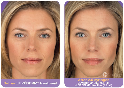 Dermal Fillers
