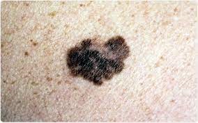 Melanoma Skin Cancer